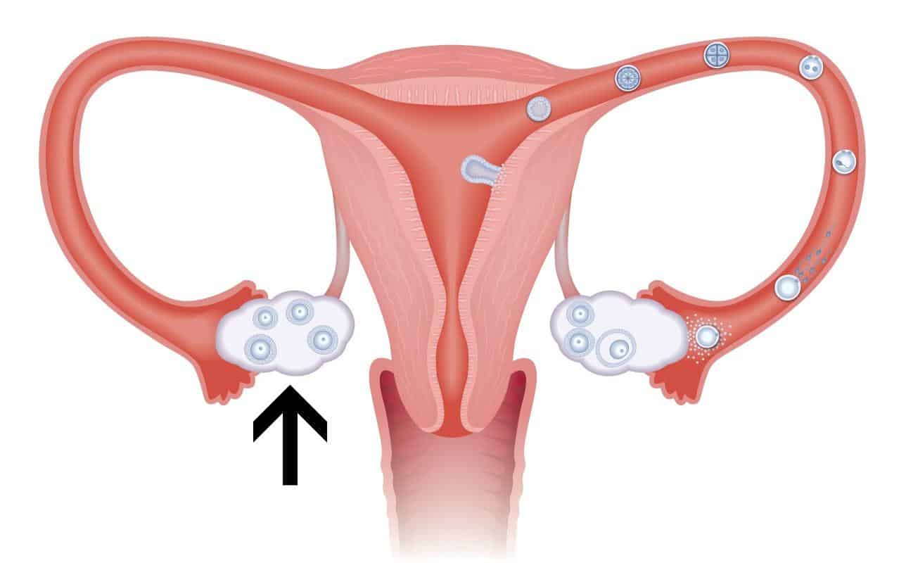 Phương pháp chữa vô sinh cho nữ giới bị suy buồng trứng 4