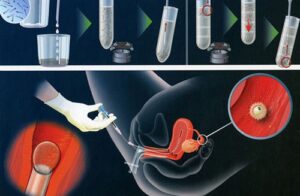 bơm tinh trùng vào buồng tử cung 4