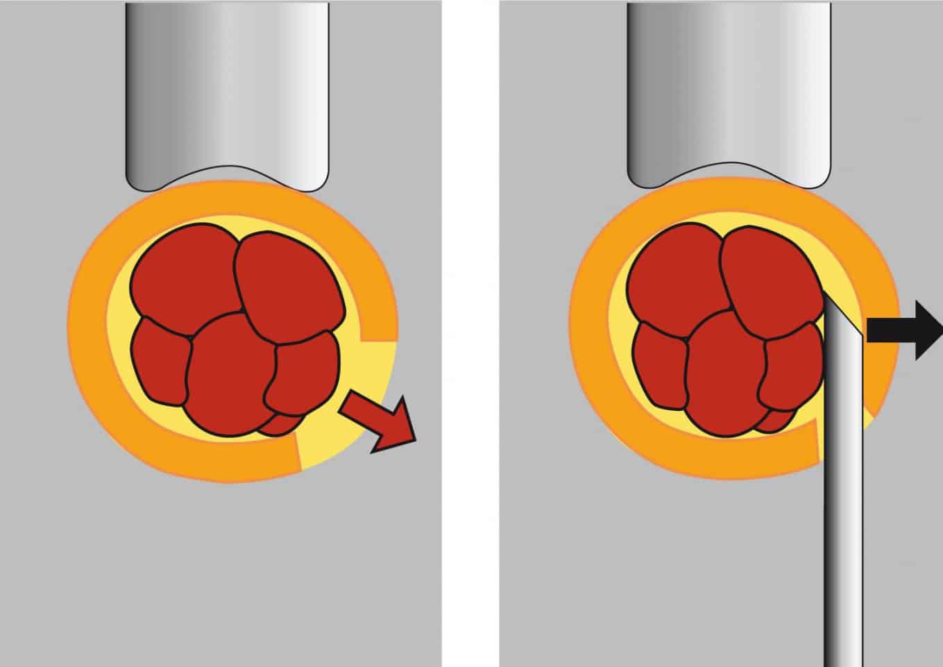 Tăng khả năng có thai 1 Tăng khả năng có thai nhờ hỗ trợ phôi thoát màng, hỗ trợ phôi thoát màng, Tăng khả năng có thai
