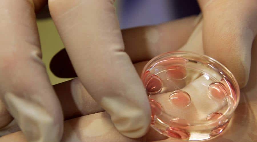 vô sinh vì viêm lộ tuyến cổ tử cung 1