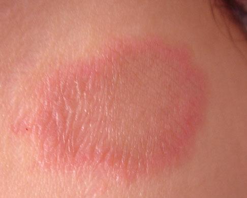 Dị ứng tinh dịch có gây vô sinh không? Di-ung-tinh-dich-co-gay-vo-sinh-khong2