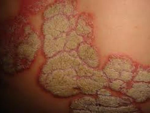 Những bệnh tình dục nguy hiểm nhung-benh-tinh-duc-nguy-hiem-3