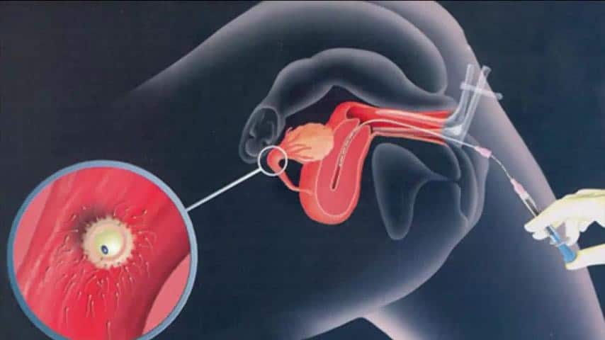 8 kỹ thuật đột phá trong hỗ trợ sinh sản 8-ky-thuat-dot-pha-trong-ho-tro-sinh-san-3