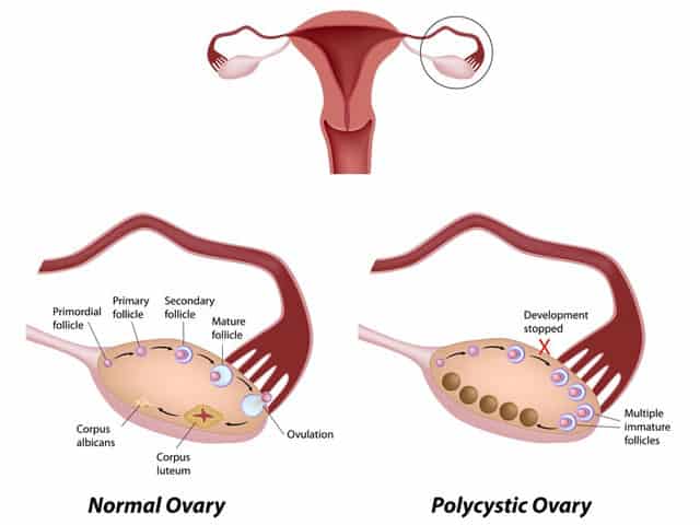 Những bệnh dễ gây vô sinh nữ giới nhung-benh-de-gay-vo-sinh-nu-gioi-2.