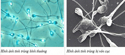 Cách điều trị tinh trùng vón cục ở nam giới cach-dieu-tri-tinh-trung-von-cuc-o-nam-gioi-1