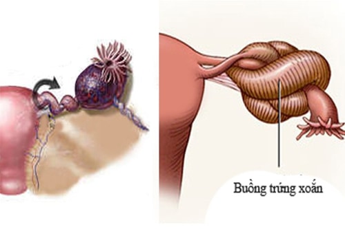 Biến chứng nguy hiểm khi bị u bì buồng trứng nhung-dieu-can-biet-ve-benh-u-bi-buong-trung-2