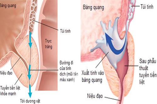 Xuất tinh ngược dòng 8-can-benh-chu-yeu-gay-vo-sinh-nam-0