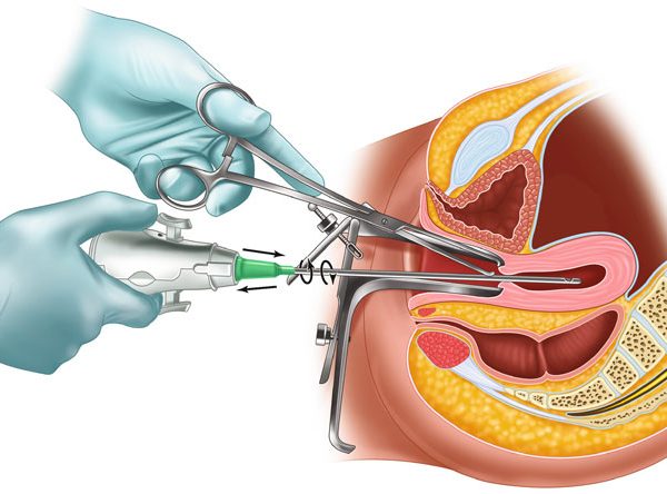 nao-pha-thai-gay-vo-sinh