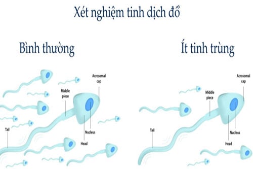 Đàn ông ít tinh trùng thường ốm yếu và mắc nhiều bệnh Tinh trùng ít ảnh hưởng tới khả năng thụ thai của các cặp vợ chồng