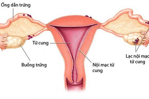 U nang buồng trứng: Lạc nội mạc tử cung