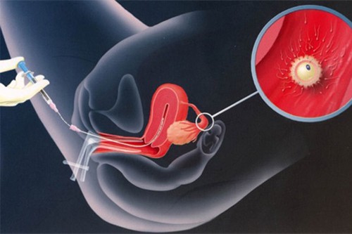 Lưu ý khi làm IVF