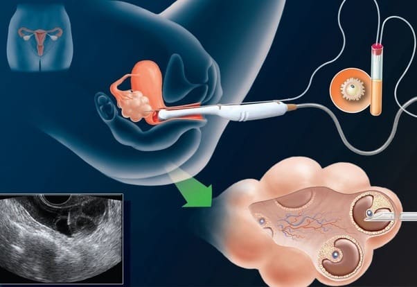 Chọc hút trứng khi thụ tinh ống nghiệm (IVF) - GOTOSAN TW3