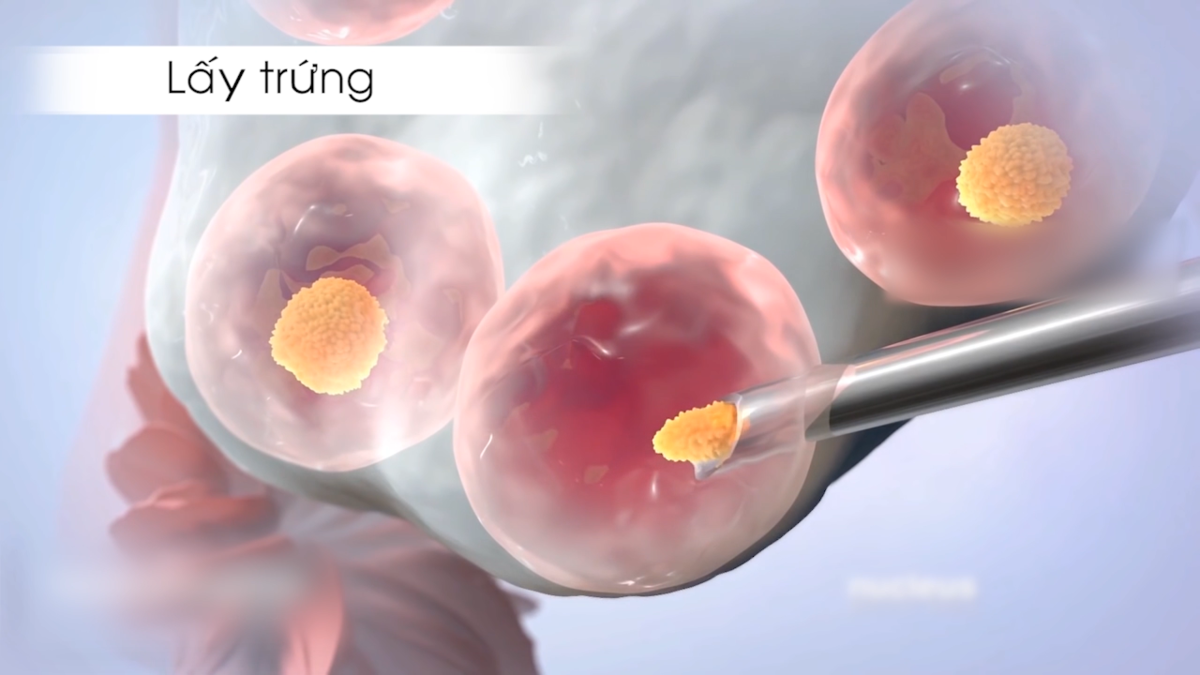 Chọc hút trứng khi thụ tinh ống nghiệm (IVF)