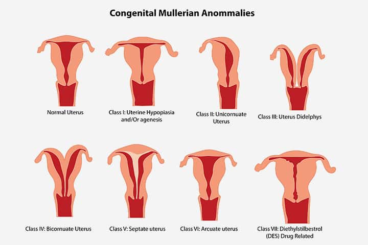 Bất thường tử cung bẩm sinh: Những bất thường tử cung bẩm sinh sẽ ảnh hưởng đến sức khỏe cả mẹ và em bé. Với những hình ảnh siêu âm từ chuyên gia y tế hàng đầu, chúng tôi sẽ giúp bạn kiểm tra và phát hiện sớm các bất thường đó để tránh các nguy cơ tới sức khỏe của mình và con bạn.