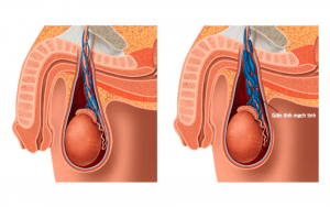 Giãn tĩnh mạch thừng tinh là nguyên nhân gây xệ tinh hoàn