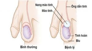 Dấu hiệu nhận biết và cách điều trị nang mào tinh hoàn