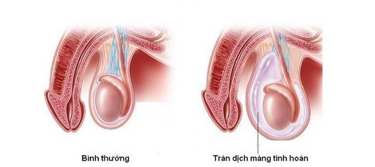 Dấu hiệu, biến chứng và nguyên nhân của tràn dịch màng tinh hoàn