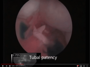 Phương pháp đánh giá vòi tử cung