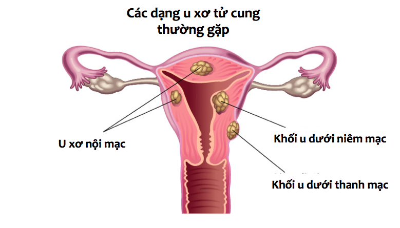 phau-thuat-trong-dieu-tri-vo-sinh-hiem-muon-1