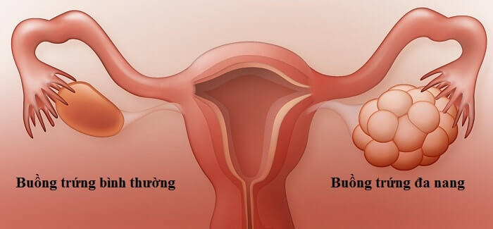 Buồng trứng đa nang có nên làm IUI hay IVF không là thắc mắc của nhiều chị em
