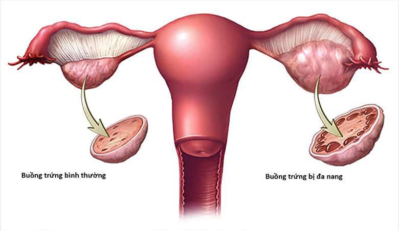 Điều trị buồng trứng đa nang như thế nào?