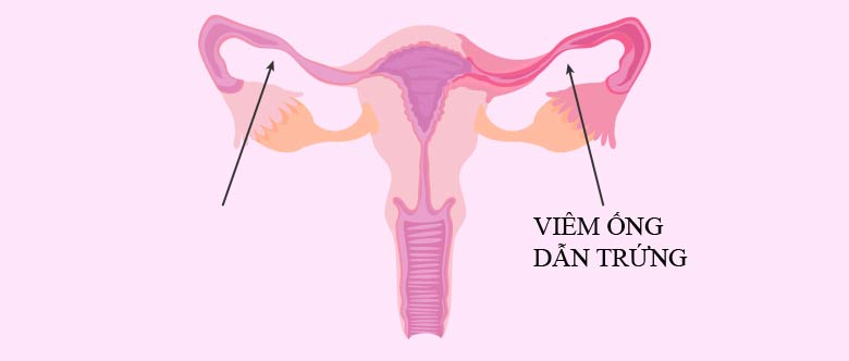 Những biến chứng có thể xảy ra khi bị viêm vòi trứng là gì?
