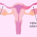 Viêm ống dẫn trứng