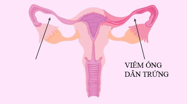 Viêm ống dẫn trứng