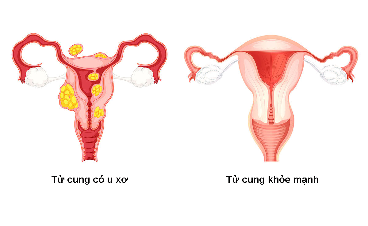 U xơ tử cung loại 7 có ảnh hưởng gì đến khả năng sinh sản? 
