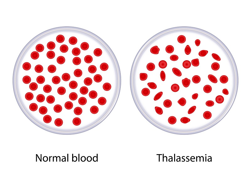 tan máu bẩm sinh thalessemia