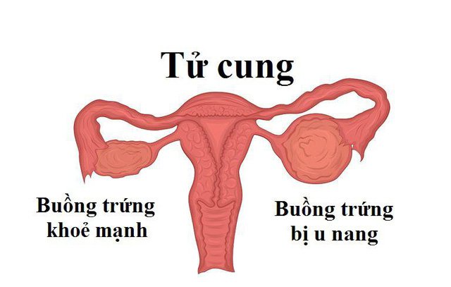 Nang sinh lý buồng trứng trái là gì? Tìm hiểu về nguyên nhân, triệu chứng và cách điều trị