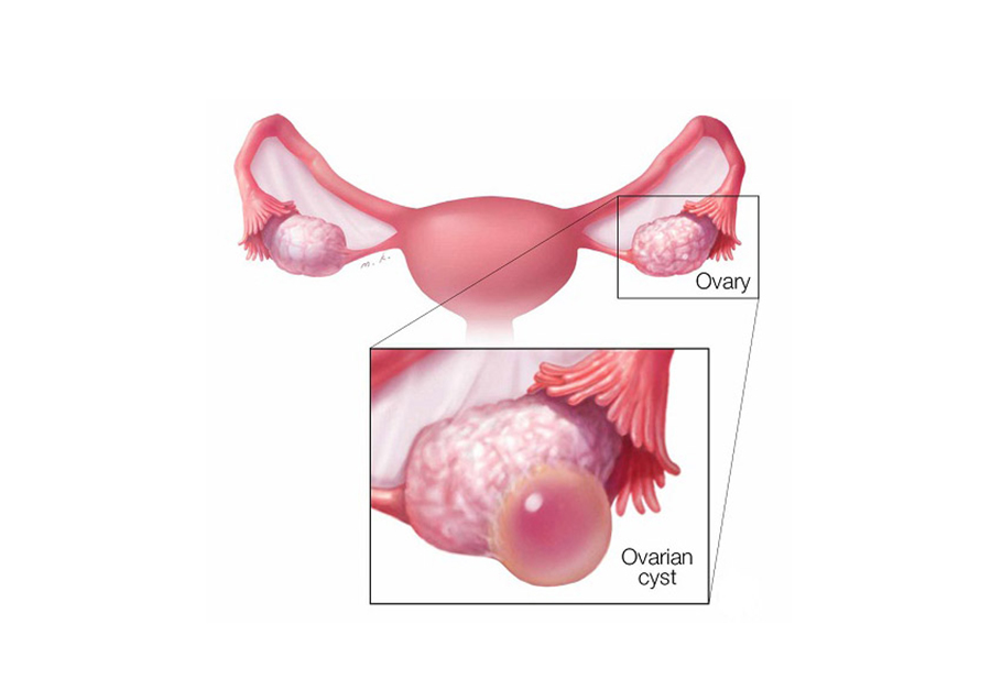 Nang nước buồng trứng